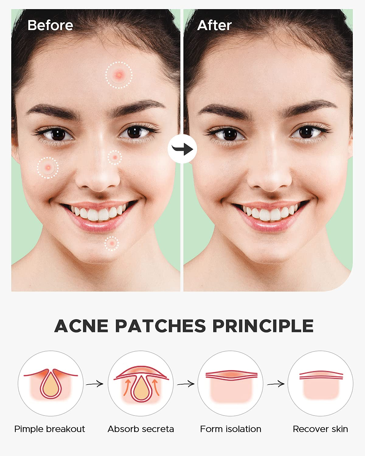 Acne Pimple Patch (180 Counts 4 Sizes), Invisible Hydrocolloid Acne Patch with Tea Tree Oil & Calendula Oil, Acne Spot Patch Zit Patches for Face